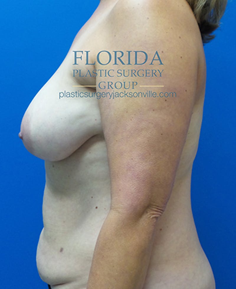 Mommy Makeover Before & After Gallery - Patient 154949104 - Image 9