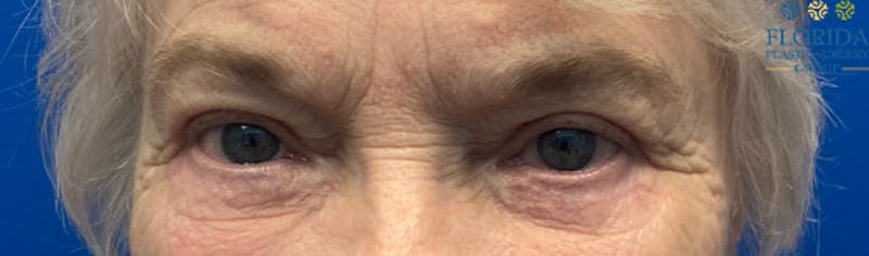 Blepharoplasty Before & After Gallery - Patient 154949112 - Image 2