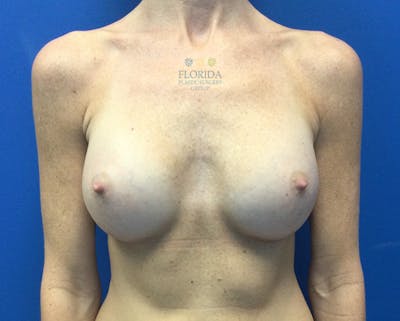 Silicone Breast Augmentation Before & After Gallery - Patient 154949116 - Image 2