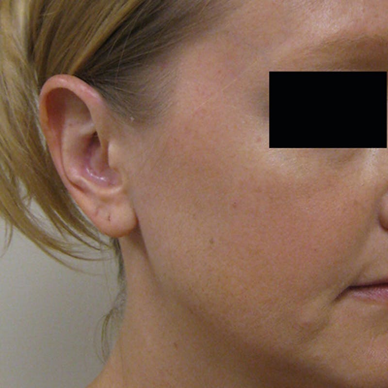 Otoplasty Before & After Gallery - Patient 154949108 - Image 4