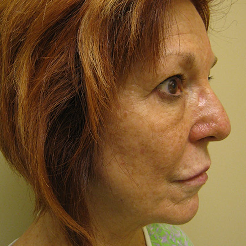 Facial Rejuvenation Before & After Gallery - Patient 154949106 - Image 3