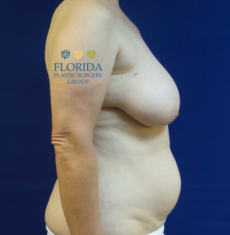 DIEP Flap Reconstruction Before & After Gallery - Patient 154949107 - Image 3