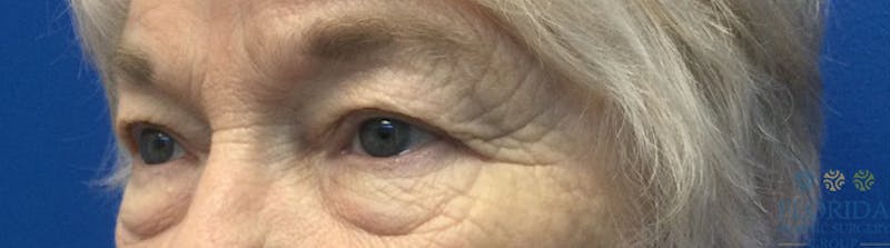 Blepharoplasty Before & After Gallery - Patient 154949112 - Image 3