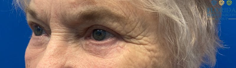 Blepharoplasty Before & After Gallery - Patient 154949112 - Image 4