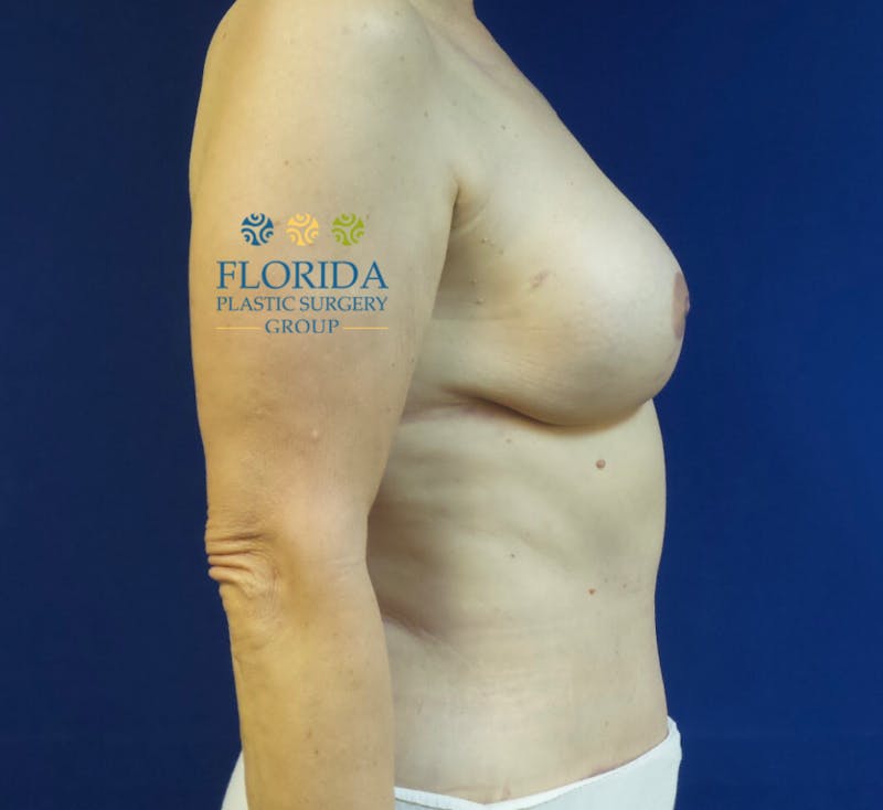 DIEP Flap Reconstruction Before & After Gallery - Patient 154949107 - Image 4