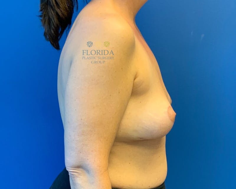Breast Implant Removal Before & After Gallery - Patient 154949109 - Image 4