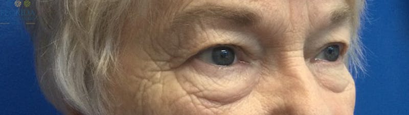 Blepharoplasty Before & After Gallery - Patient 154949112 - Image 5