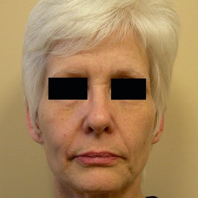 Facial Rejuvenation Before & After Gallery - Patient 154949123 - Image 1