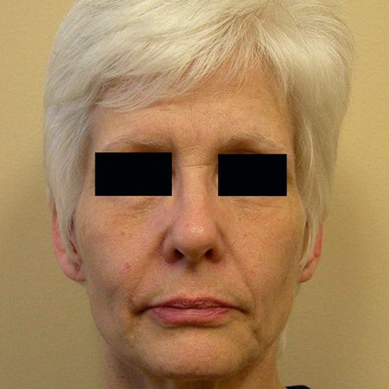 Facial Rejuvenation Before & After Gallery - Patient 154949123 - Image 1
