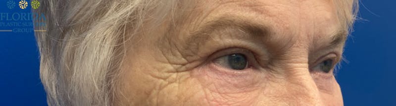 Blepharoplasty Before & After Gallery - Patient 154949112 - Image 6