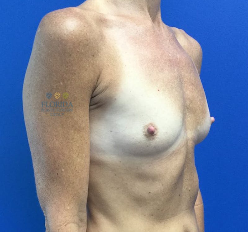 Silicone Breast Augmentation Before & After Gallery - Patient 154949116 - Image 5