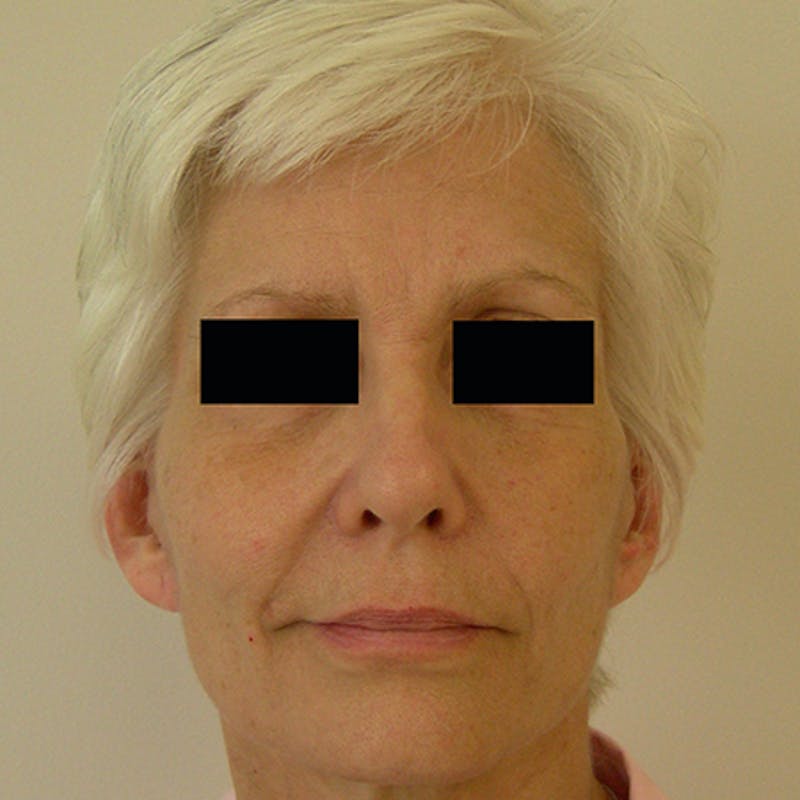 Facial Rejuvenation Before & After Gallery - Patient 154949123 - Image 2