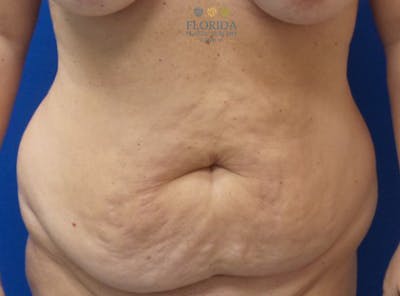 Abdominoplasty Before & After Gallery - Patient 154949117 - Image 1