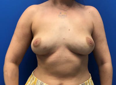 Breast Implant Removal Before & After Gallery - Patient 154949118 - Image 2