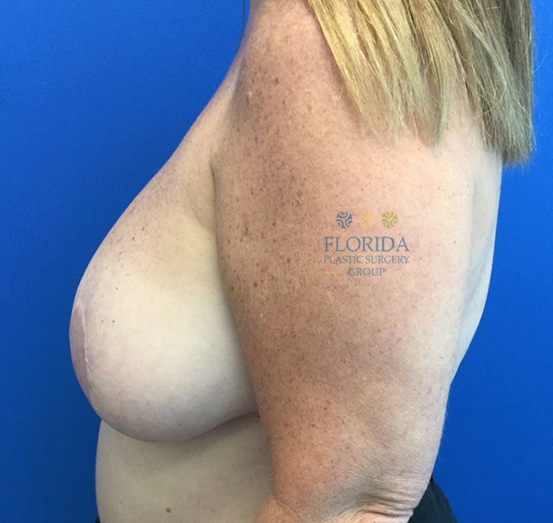 Augmentation Mastopexy Before & After Gallery - Patient 154949122 - Image 3