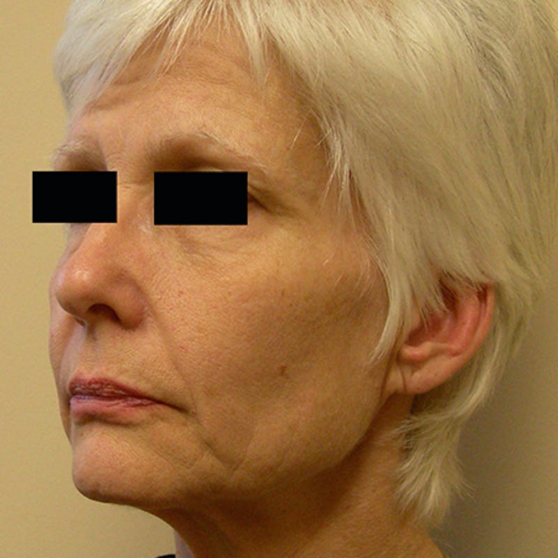Facial Rejuvenation Before & After Gallery - Patient 154949123 - Image 3