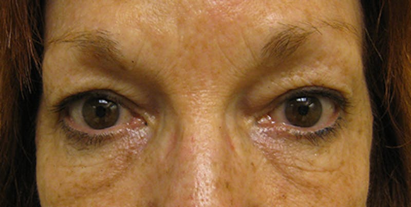 Blepharoplasty Before & After Gallery - Patient 154949125 - Image 1