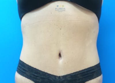 Abdominoplasty Before & After Gallery - Patient 154949117 - Image 2