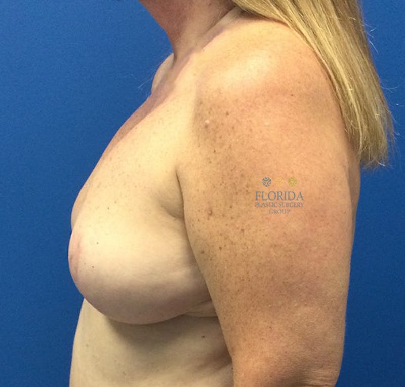 Augmentation Mastopexy Before & After Gallery - Patient 154949122 - Image 4