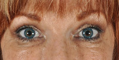 Blepharoplasty Before & After Gallery - Patient 154949125 - Image 2