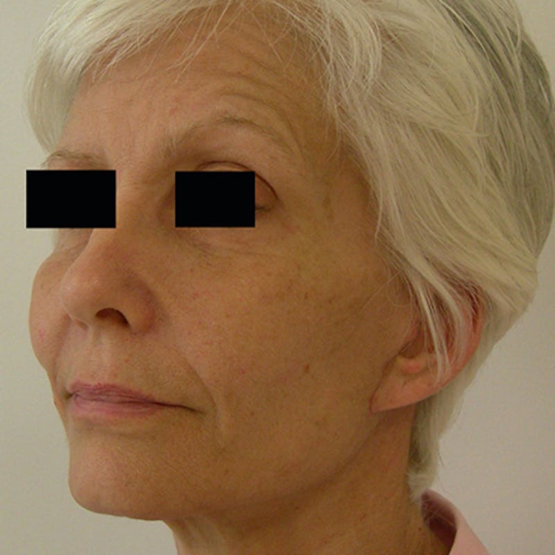 Facial Rejuvenation Before & After Gallery - Patient 154949123 - Image 4