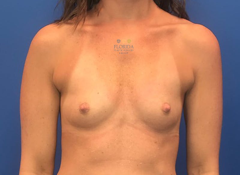 Silicone Breast Augmentation Before & After Gallery - Patient 154949132 - Image 1