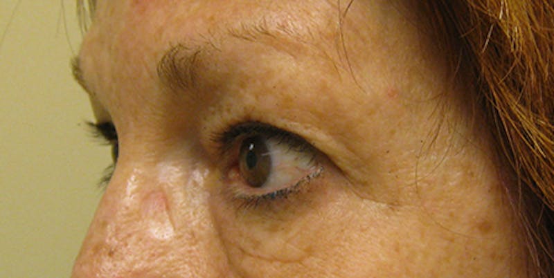 Blepharoplasty Before & After Gallery - Patient 154949125 - Image 3