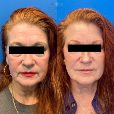 Injectables and Dermal Fillers Before & After Gallery - Patient 154949120 - Image 1