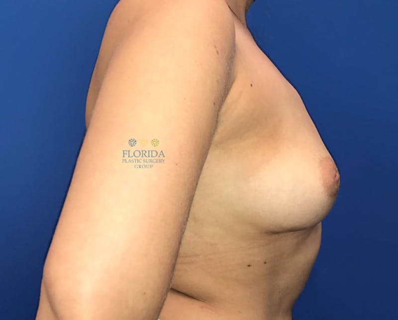 Breast Implant Removal Before & After Gallery - Patient 154949118 - Image 4