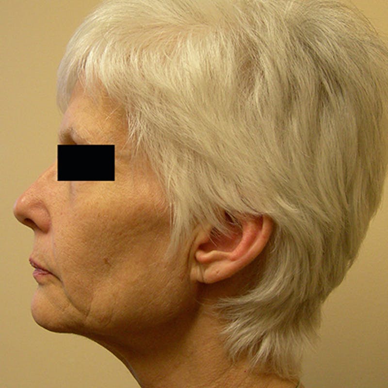 Facial Rejuvenation Before & After Gallery - Patient 154949123 - Image 5