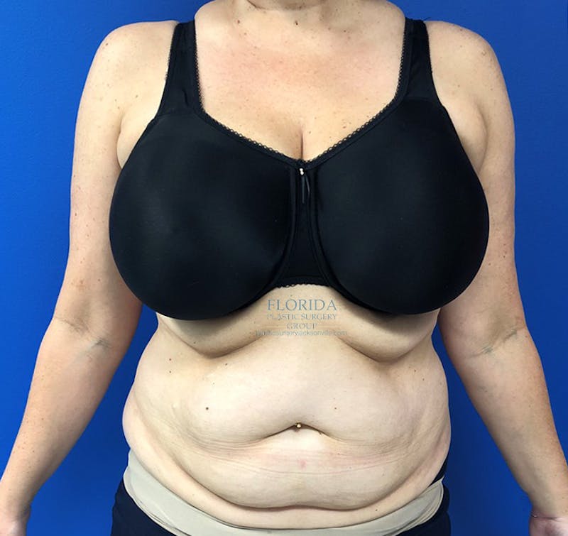 Abdominoplasty Before & After Gallery - Patient 154949142 - Image 1