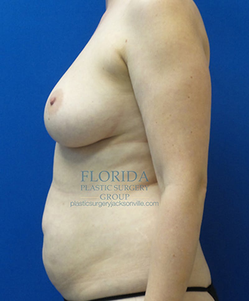 Nipple Sparing Breast Reconstruction Before & After Gallery - Patient 154949126 - Image 7