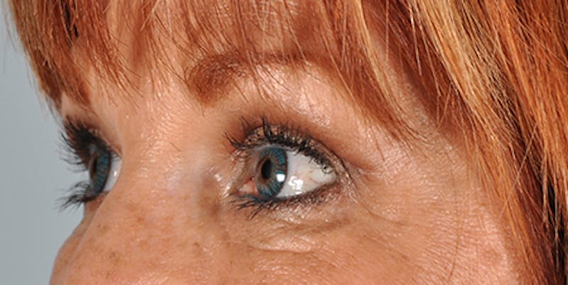 Blepharoplasty Before & After Gallery - Patient 154949125 - Image 4