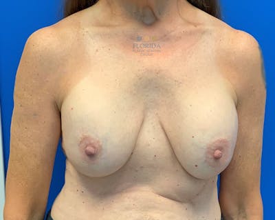 Breast Implant Removal Before & After Gallery - Patient 154949133 - Image 1