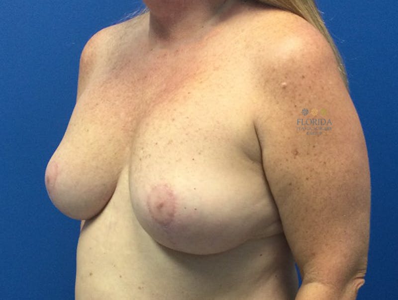 Augmentation Mastopexy Before & After Gallery - Patient 154949122 - Image 6
