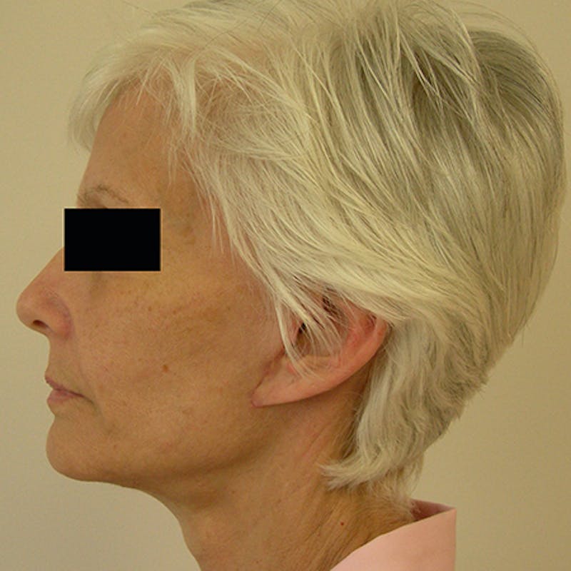 Facial Rejuvenation Before & After Gallery - Patient 154949123 - Image 6