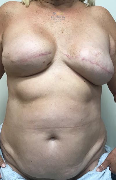 DIEP Flap Reconstruction Before & After Gallery - Patient 154949134 - Image 1