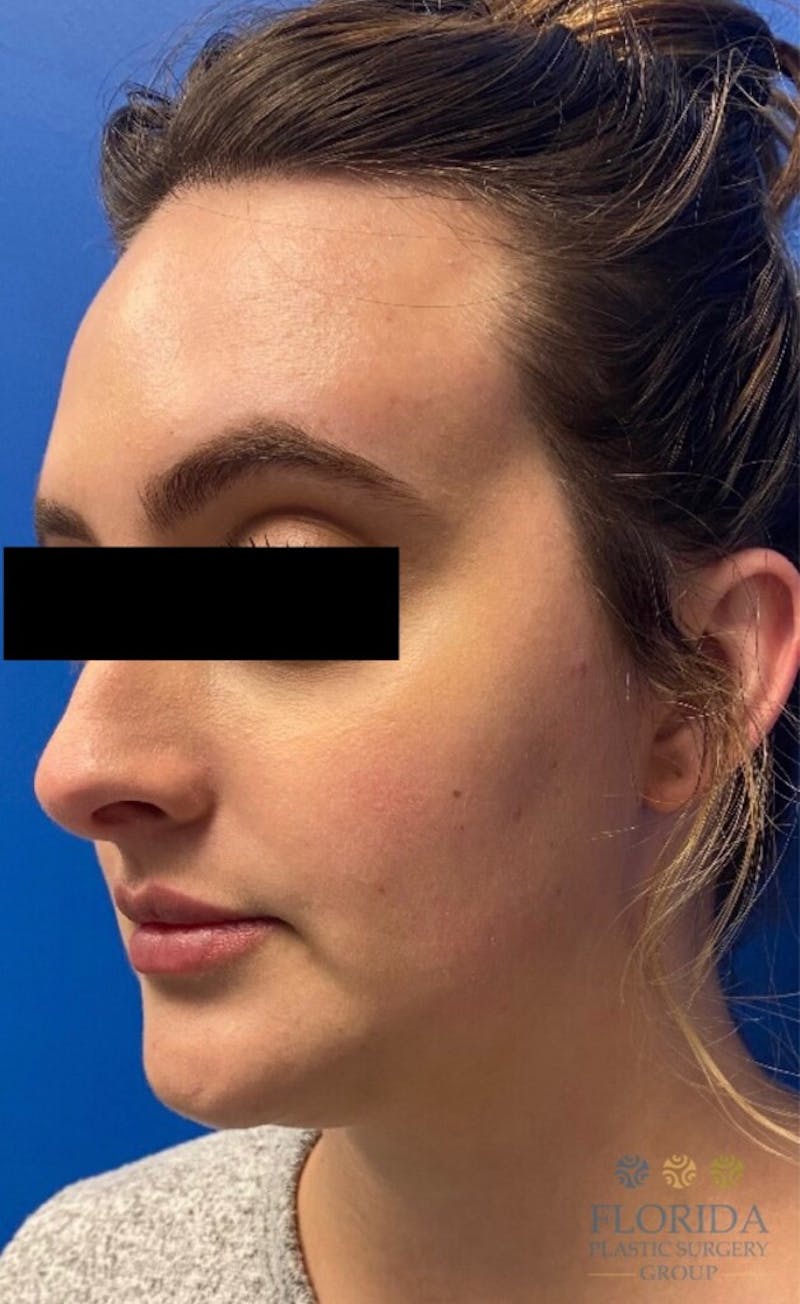 Injectables and Dermal Fillers Before & After Gallery - Patient 154949124 - Image 1
