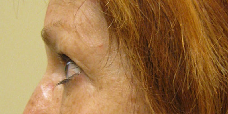 Blepharoplasty Before & After Gallery - Patient 154949125 - Image 5