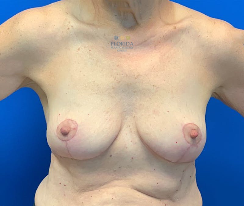 Breast Implant Removal Before & After Gallery - Patient 154949133 - Image 2