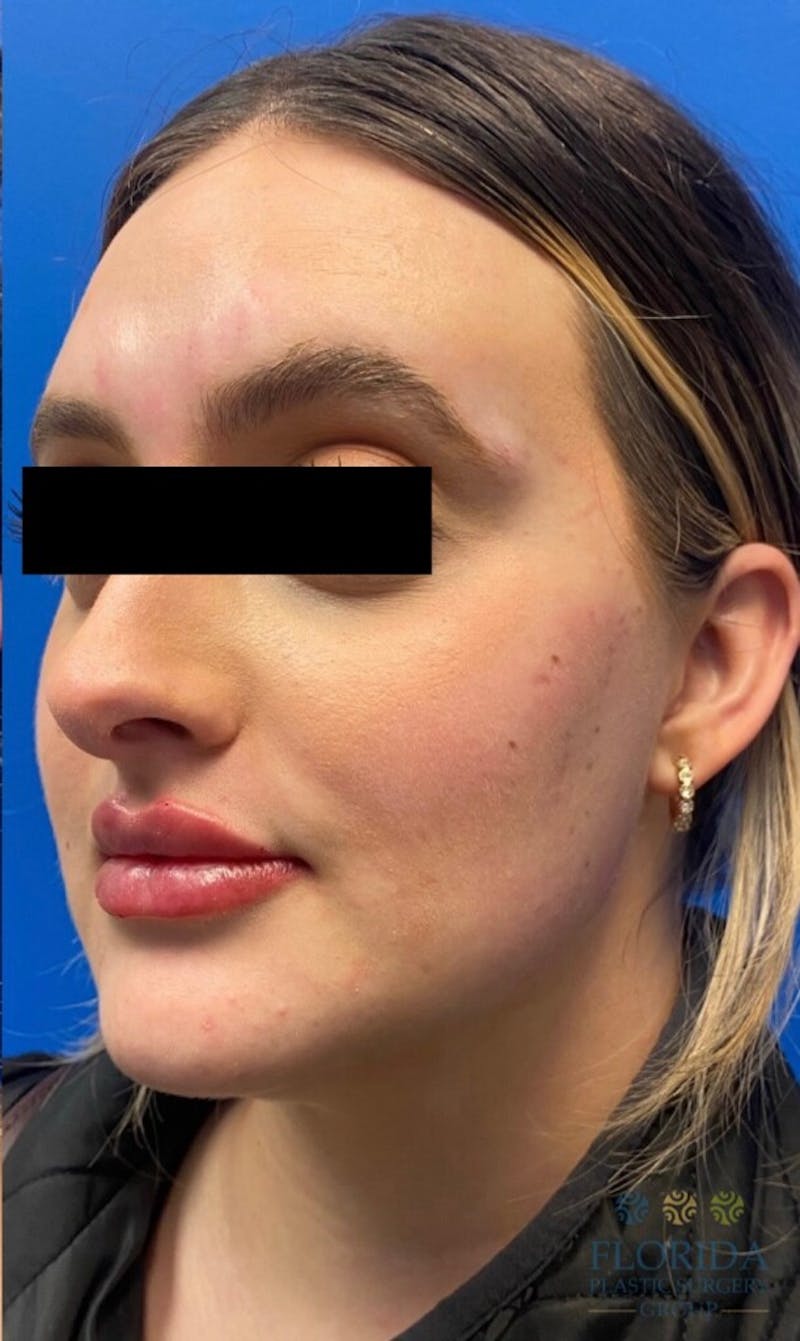 Injectables and Dermal Fillers Before & After Gallery - Patient 154949124 - Image 2