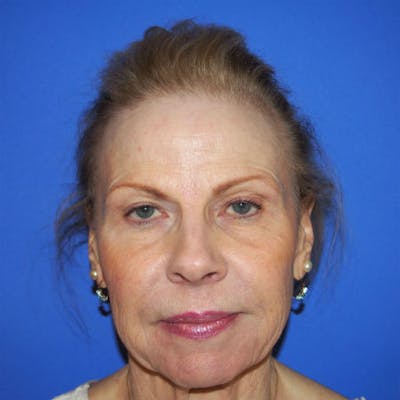 Facial Rejuvenation Before & After Gallery - Patient 154949131 - Image 1