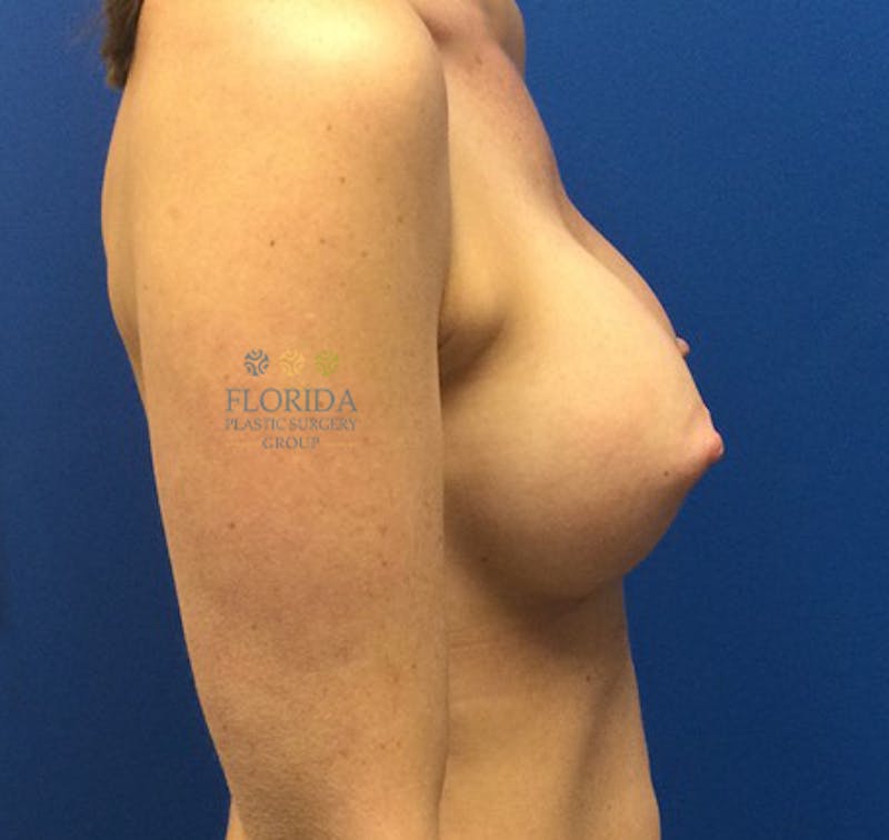 Silicone Breast Augmentation Before & After Gallery - Patient 154949132 - Image 4