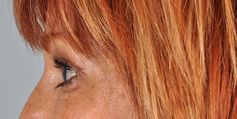 Blepharoplasty Before & After Gallery - Patient 154949125 - Image 6