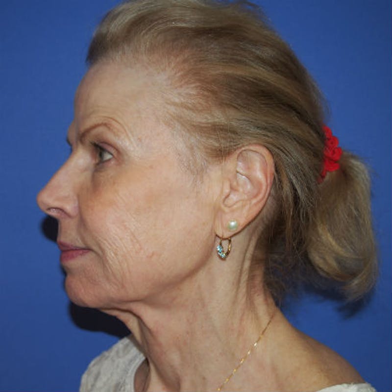 Facial Rejuvenation Before & After Gallery - Patient 154949131 - Image 3