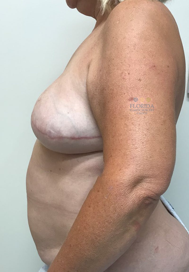 DIEP Flap Reconstruction Before & After Gallery - Patient 154949134 - Image 3