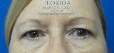 Blepharoplasty Before & After Gallery - Patient 154949139 - Image 1