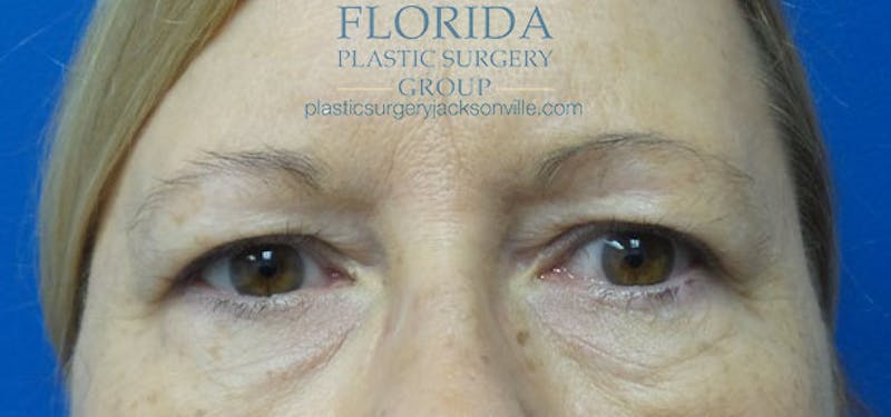 Blepharoplasty Before & After Gallery - Patient 154949139 - Image 1