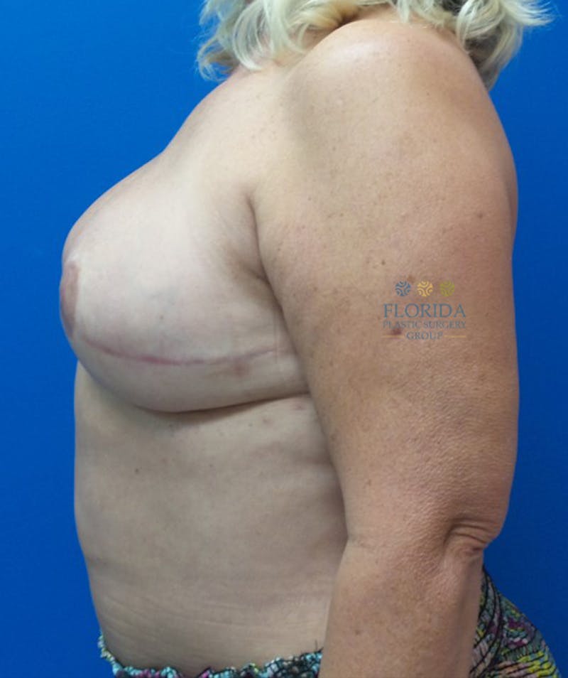 DIEP Flap Reconstruction Before & After Gallery - Patient 154949134 - Image 4