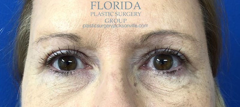 Blepharoplasty Before & After Gallery - Patient 154949139 - Image 2
